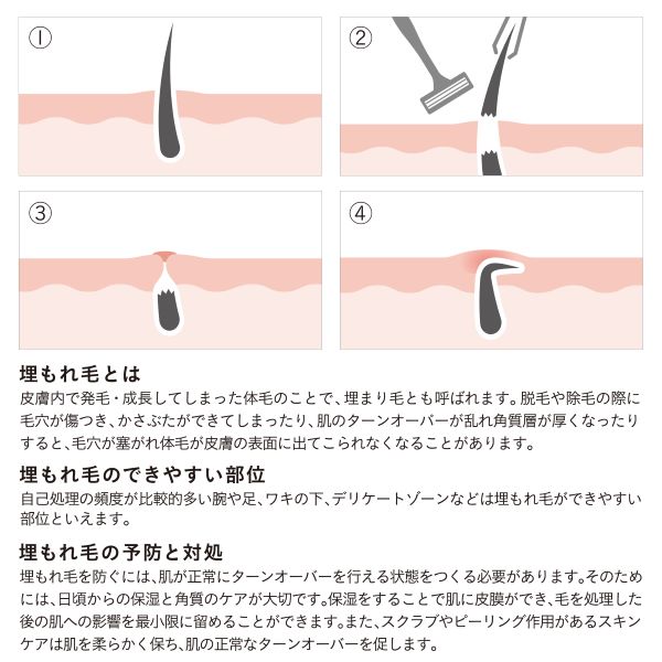 iroha（イロハ） VIO トリートメントローション　100mlは、デリケートゾーンの埋もれ毛の予防にもおすすめです。